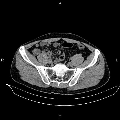 File:Adrenal myelolipoma (Radiopaedia 87794-104246 Axial non-contrast 82).jpg