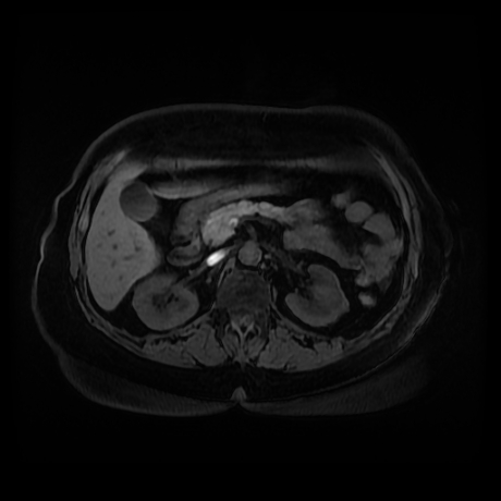 Adrenal myelolipoma - MRI (Radiopaedia 83249-97646 Axial T1 fat sat 38).jpg