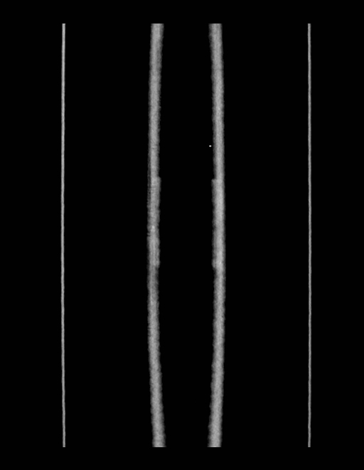 Adrenal myelolipoma - bilateral (Radiopaedia 74805-85810 Coronal C+ portal venous phase 6).jpg