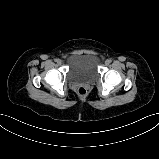 Adrenocortical carcinoma (Radiopaedia 87281-103569 Axial non-contrast 85).jpg