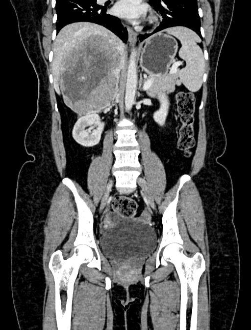 Adrenocortical carcinoma (Radiopaedia 87281-103569 Coronal C+ portal venous phase 62).jpg