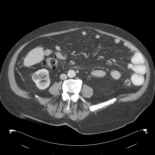 Adult ileal intussusception with secondary obstruction (Radiopaedia 30395-31051 Axial C+ portal venous phase 44).jpg