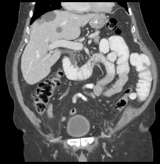 Adult ileal intussusception with secondary obstruction (Radiopaedia 30395-31051 Coronal C+ portal venous phase 27).jpg