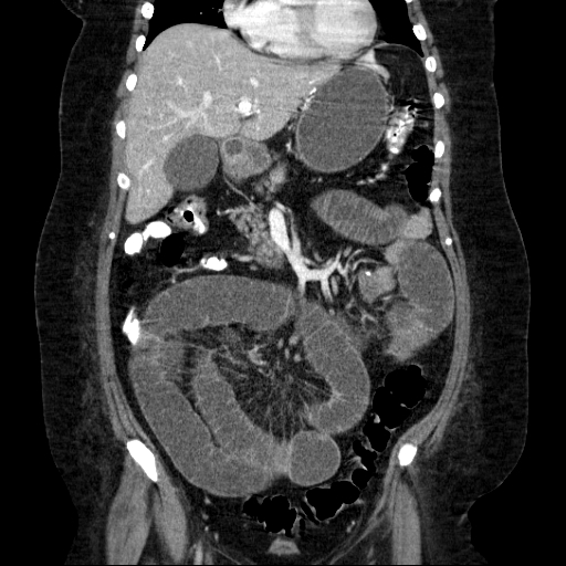 File:Afferent loop syndrome - secondary to incarcerated trocar site hernia (Radiopaedia 82959-97305 Coronal C+ portal venous phase 65).jpg