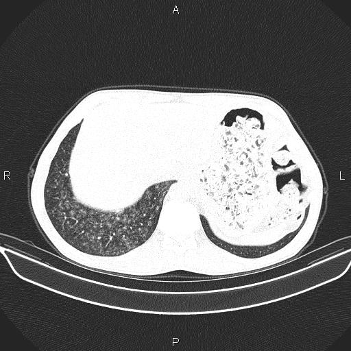 Air bronchogram in pneumonia (Radiopaedia 85719-101512 Axial lung window 61).jpg