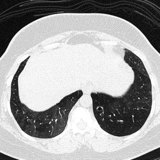 Air trapping in small airway disease (Radiopaedia 61685-69694 Axial lung window 158).jpg
