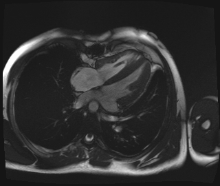 File:Alagille syndrome with pulmonary hypertension (Radiopaedia 49384-54502 E 1).jpg