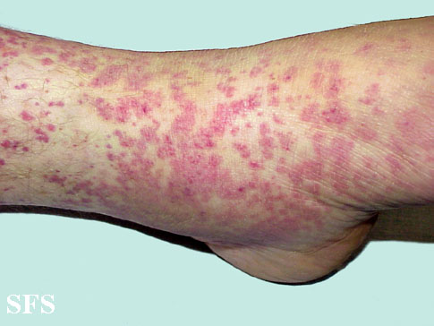 Allergic Vasculitis (Dermatology Atlas 5).jpg