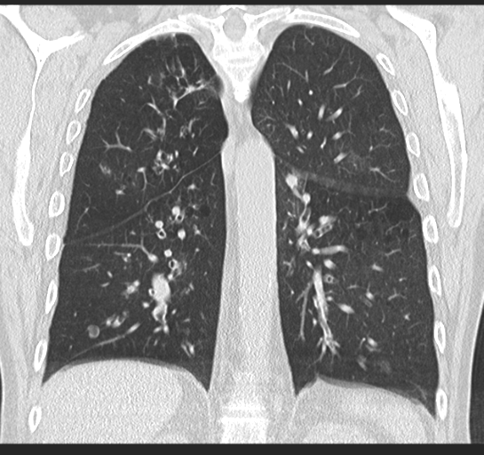 Allergic bronchopulmonary aspergillosis (Radiopaedia 44760-48571 Coronal lung window 39).png