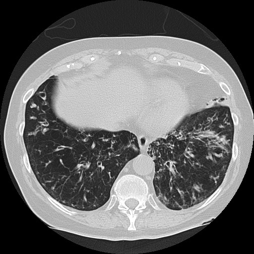 Alpha-1-antitrypsin deficiency (Radiopaedia 72058-82557 Axial lung window 56).jpg