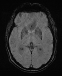 File:Alzheimer's disease- with Gerstmann syndrome and dressing apraxia (Radiopaedia 54882-61150 Axial SWI 17).png