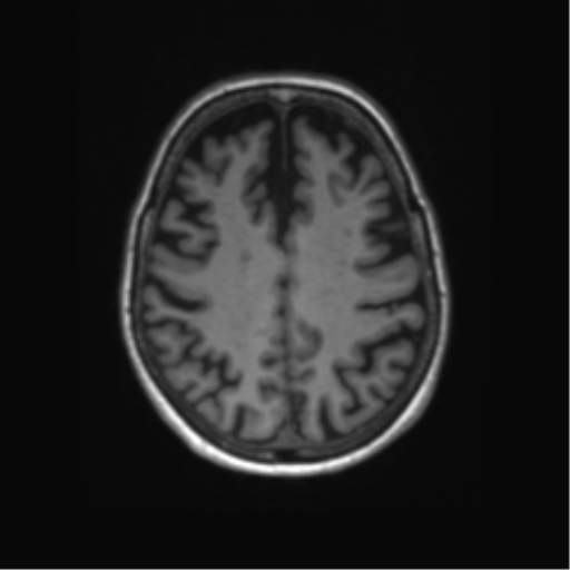 File:Alzheimer's disease (Radiopaedia 42658-45802 Axial T1 51).png