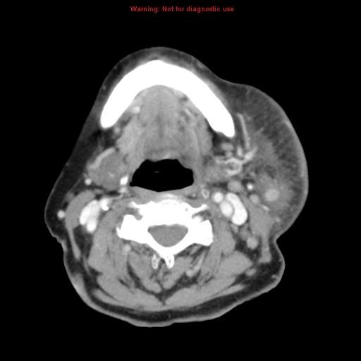 Ameloblastoma (Radiopaedia 27437-27631 A 51).jpg