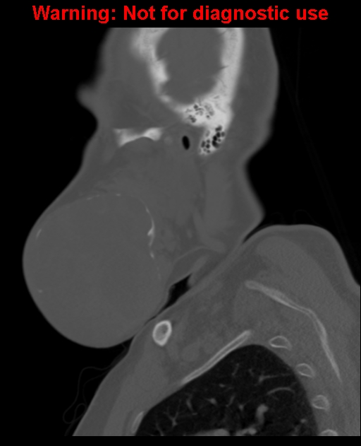Ameloblastoma (Radiopaedia 33126-34164 Sagittal bone window 18).jpg