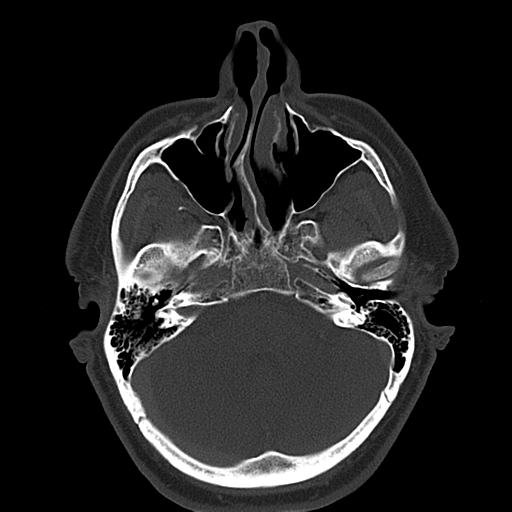 Ameloblastoma (Radiopaedia 38520-40623 Axial bone window 12).png