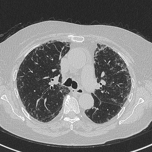 File:Amiodarone-induced pulmonary fibrosis (Radiopaedia 82355-96460 Axial lung window 27).jpg