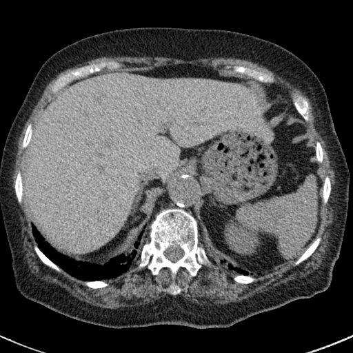 File:Amiodarone-induced pulmonary fibrosis (Radiopaedia 82355-96460 Axial non-contrast 55).jpg