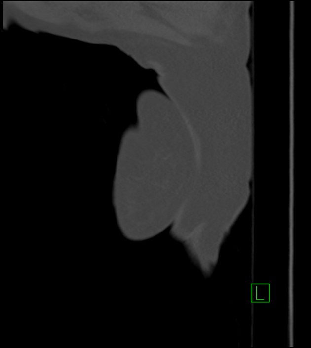 Amiodarone deposition in the liver (Radiopaedia 77587-89780 Sagittal bone window 103).jpg