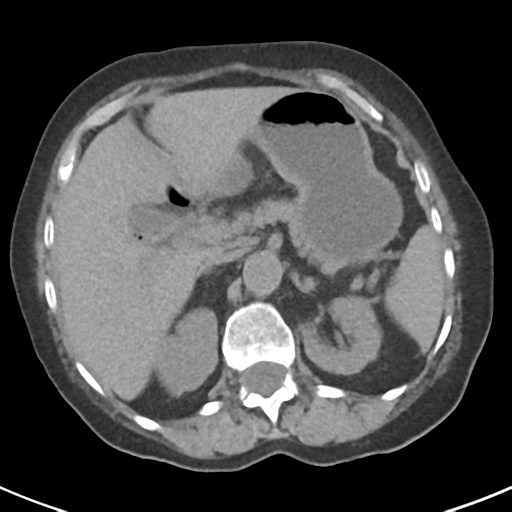 File:Ampullary adenocarcinoma (Radiopaedia 34013-35237 Axial non-contrast 15).png
