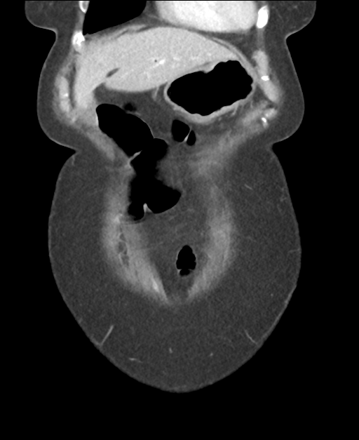 Ampullary adenocarcinoma (Radiopaedia 34013-35237 E 11).png