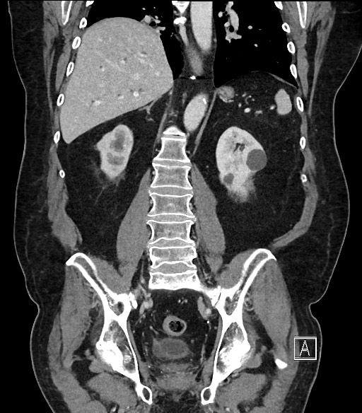 Ampullary adenocarcinoma (Radiopaedia 59373-66734 D 73).jpg
