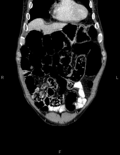 Ampullary adenocarcinoma (Radiopaedia 86093-102032 C 10).jpg