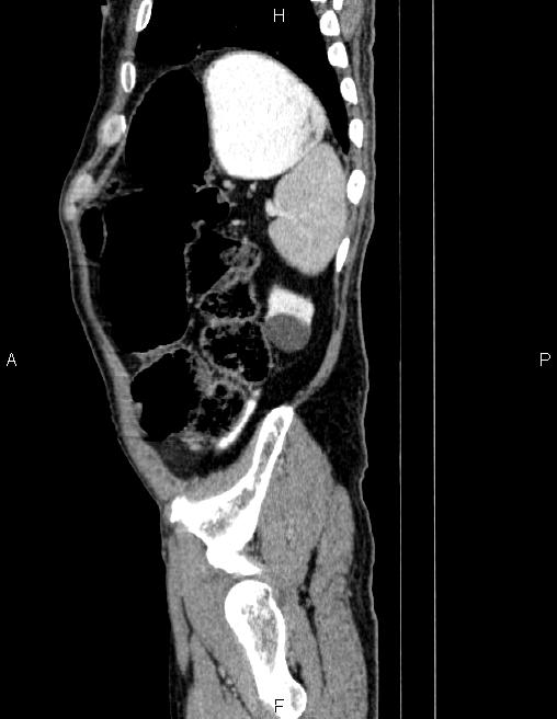 Ampullary adenocarcinoma (Radiopaedia 86093-102032 D 83).jpg