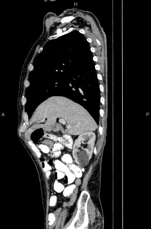 Ampullary adenocarcinoma (Radiopaedia 86093-102033 E 25).jpg
