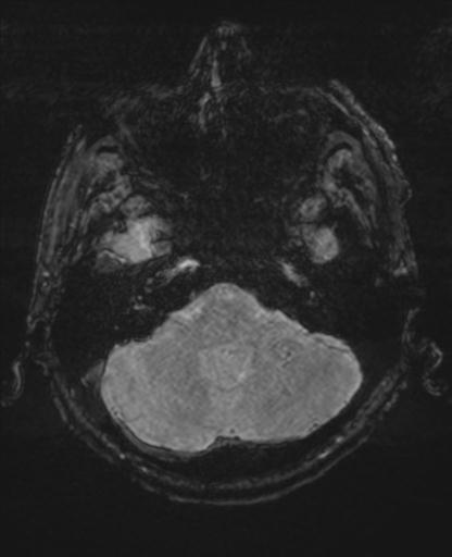 Amyloid angiopathy with inflammation (Radiopaedia 30360-31002 Axial SWI MAG 5).jpg