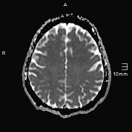 File:Amyotrophic lateral sclerosis (Radiopaedia 70821-81017 Axial ADC 16).jpg