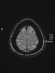 Amyotrophic lateral sclerosis (Radiopaedia 70821-81017 Axial SWI 54).jpg