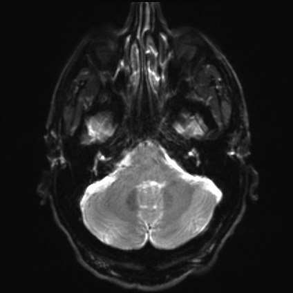 File:Amyotrophic lateral sclerosis (Radiopaedia 87352-103658 Axial DWI 5).jpg