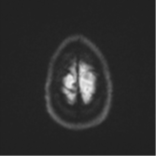 Anaplastic astrocytoma (Radiopaedia 57768-64731 Axial DWI 55).png