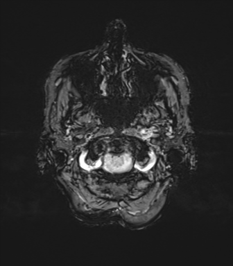 File:Anaplastic astrocytoma (Radiopaedia 86943-103160 Axial SWI 8).png