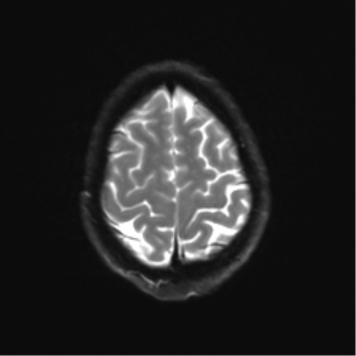 Anaplastic astrocytoma IDH mutant (Radiopaedia 50046-55341 Axial DWI 24).png