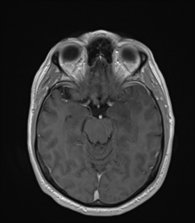 Anaplastic astrocytoma IDH wild-type (Radiopaedia 49984-55273 Axial T1 C+ 23).png