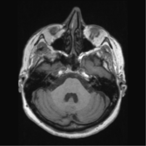 Anaplastic astrocytoma IDH wild-type (pseudoprogression) (Radiopaedia 42209-45276 Axial T1 44).png
