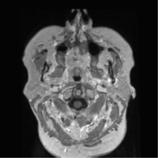 File:Anaplastic astrocytoma IDH wild-type (pseudoprogression) (Radiopaedia 42209-45278 Axial T1 C+ 12).png