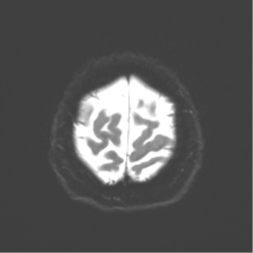 Anaplastic astrocytoma IDH wild-type (pseudoprogression) (Radiopaedia 42209-45279 Axial DWI 24).png