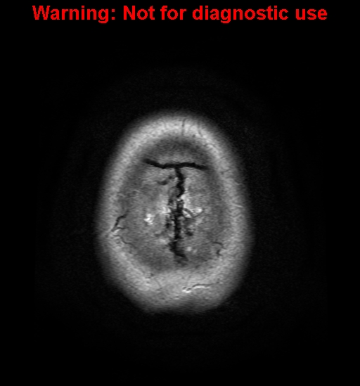 File:Anaplastic ganglioglioma (Radiopaedia 44921-48831 Axial T2 32).jpg