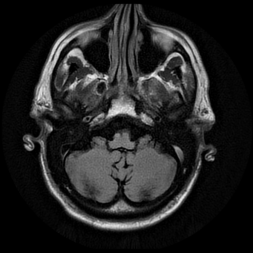 File:Anaplastic meningioma with recurrence (Radiopaedia 34452-35791 Axial FLAIR 4).png