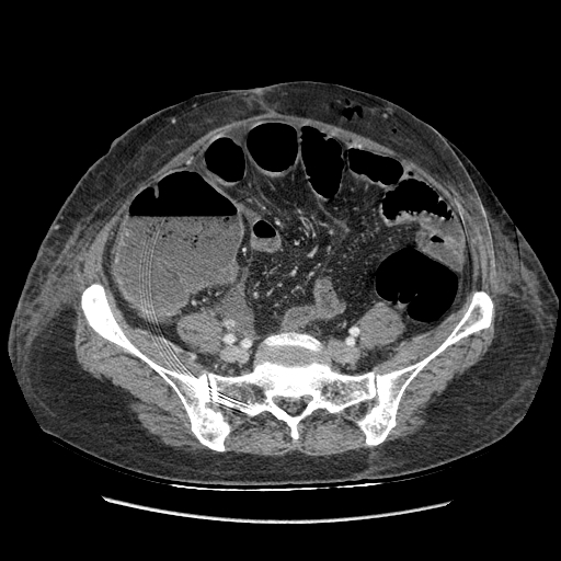 Anastomosis leak at ileostomy closure site (Radiopaedia 82138-96184 B 163).jpg