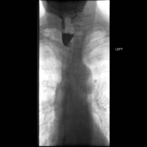 File:Anastomotic stricture post Ivor Lewis esophagectomy (Radiopaedia 47937-52715 Frontal 16).png