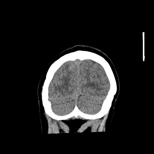 Aneursym related subarachnoid hemorrhage with hydrocephalus (Radiopaedia 45105-49083 Coronal non-contrast 59).jpg