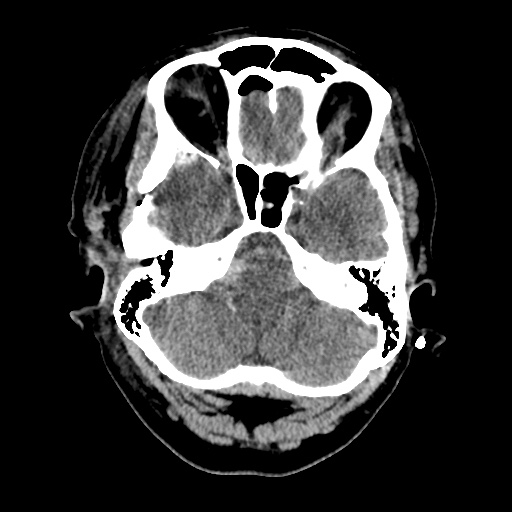 Aneursym related subarachnoid hemorrhage with hydrocephalus (Radiopaedia 45105-49085 Axial non-contrast 9).jpg