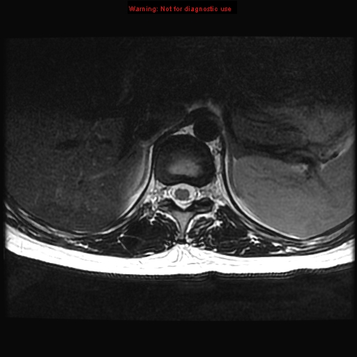File:Aneurysmal bone cyst (Radiopaedia 9419-10103 Axial T2 17).jpg