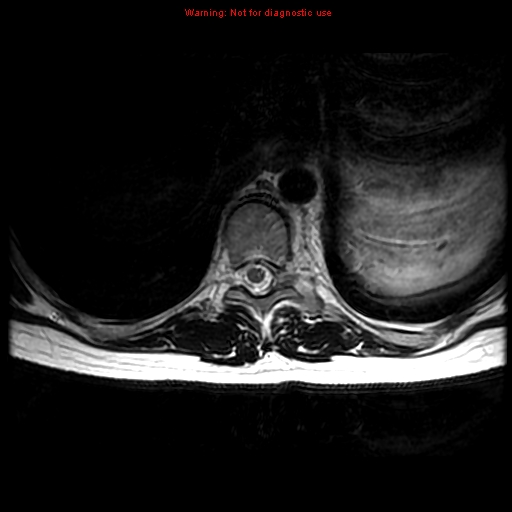 File:Aneurysmal bone cyst (Radiopaedia 9419-10103 Axial T2 8).jpg