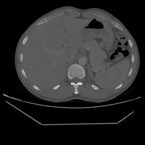 File:Aneurysmal bone cyst - rib (Radiopaedia 82167-96220 Axial bone window 242).jpg