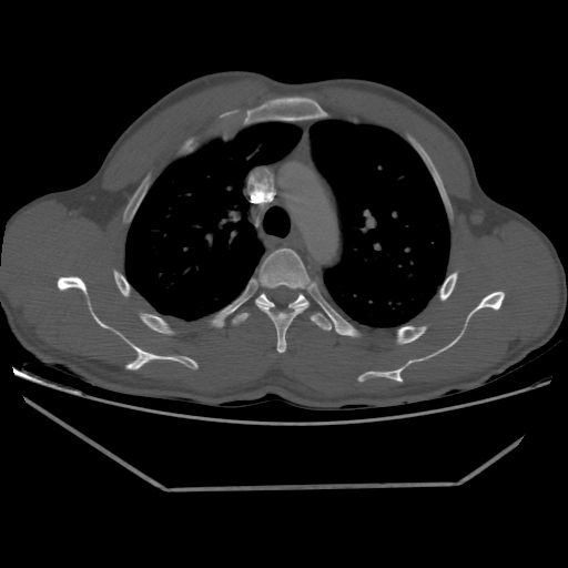 Aneurysmal bone cyst - rib (Radiopaedia 82167-96220 Axial bone window 97).jpg