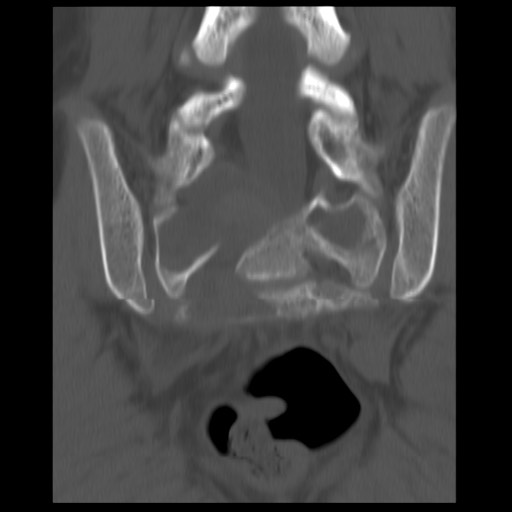 File:Aneurysmal bone cyst - sacrum (Radiopaedia 65190-74195 Coronal bone window 7).jpg